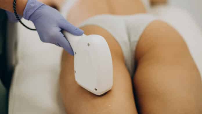 Epilation laser
